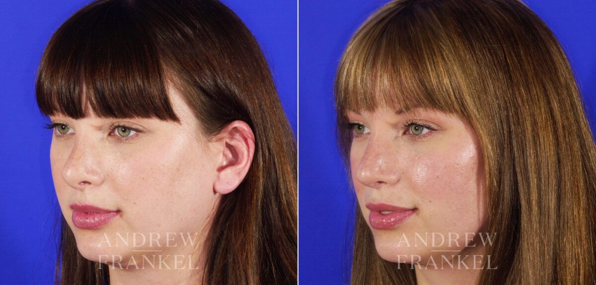 Revision Rhinoplasty before and after photos in Beverly Hills, CA, Patient 12611