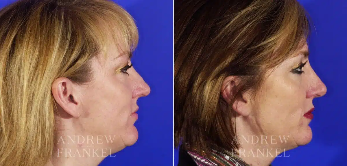 Rhinoplasty before and after photos in Beverly Hills, CA, Patient 13408