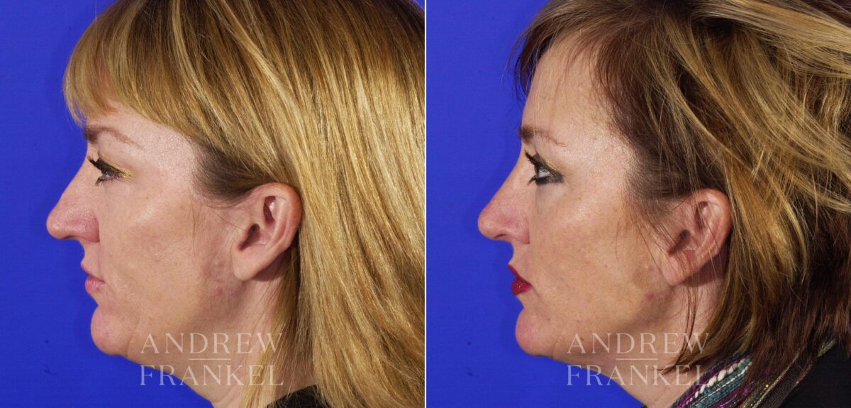 Rhinoplasty before and after photos in Beverly Hills, CA, Patient 13408