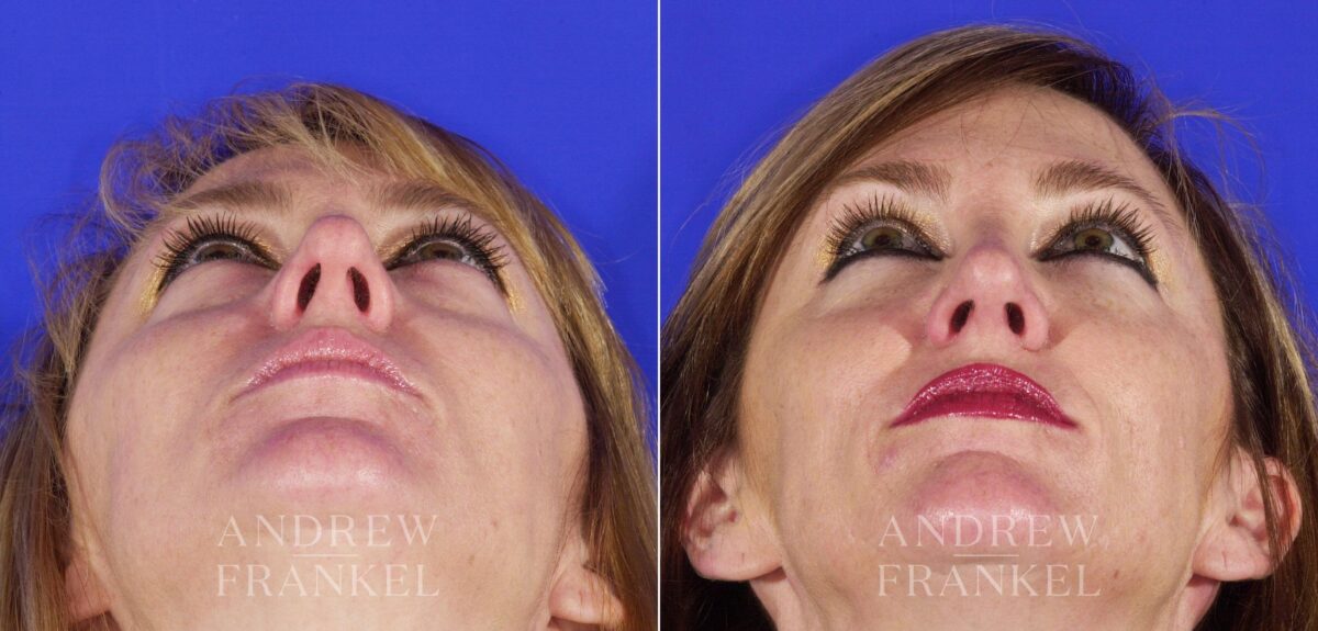 Rhinoplasty before and after photos in Beverly Hills, CA, Patient 13408