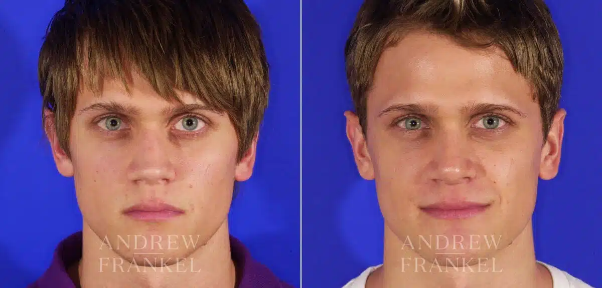 Rhinoplasty before and after photos in Beverly Hills, CA, Patient 13433