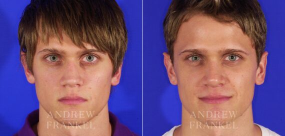 Rhinoplasty before and after photos in Beverly Hills, CA, Patient 13433