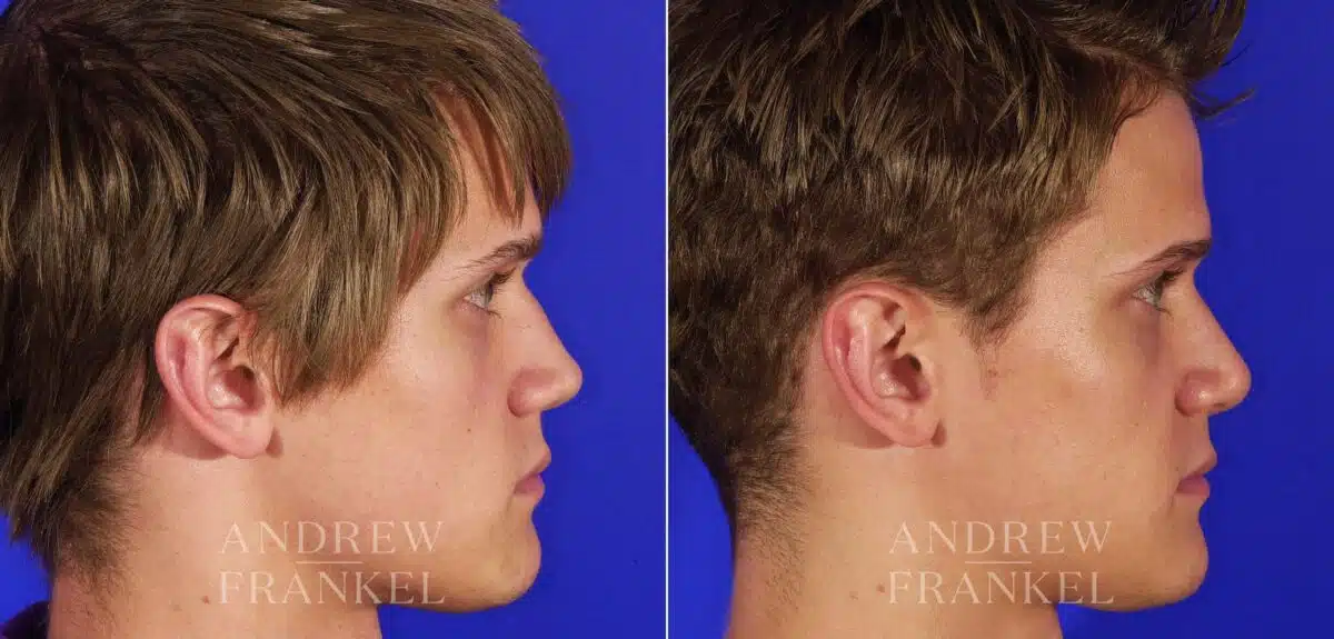Rhinoplasty before and after photos in Beverly Hills, CA, Patient 13433