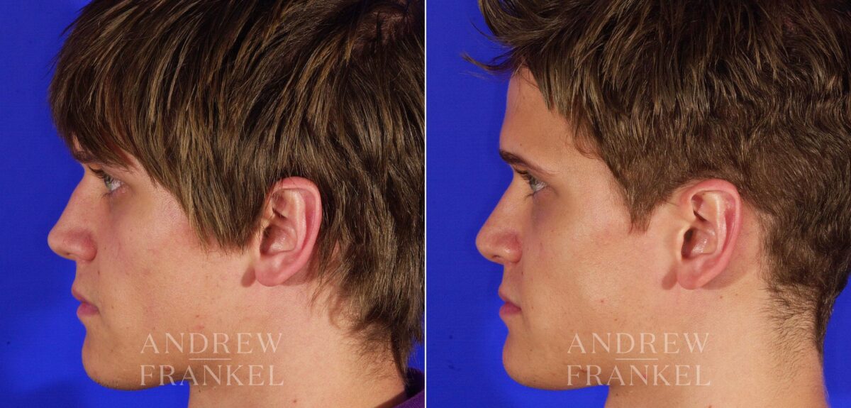 Rhinoplasty before and after photos in Beverly Hills, CA, Patient 13433