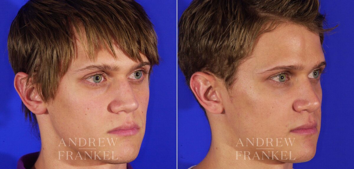 Rhinoplasty before and after photos in Beverly Hills, CA, Patient 13433