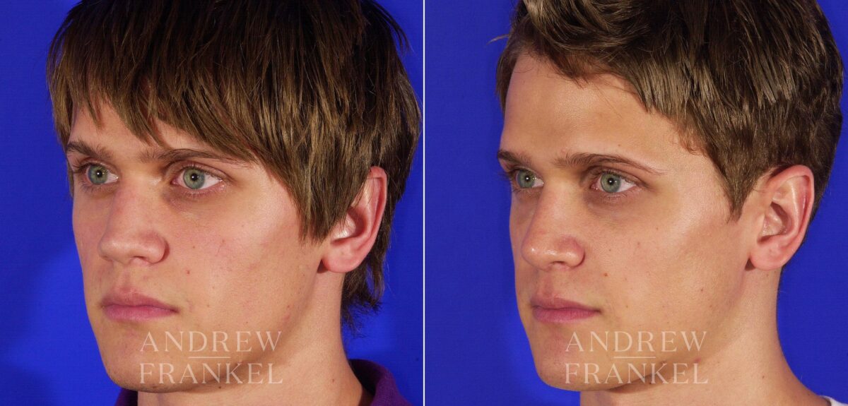Rhinoplasty before and after photos in Beverly Hills, CA, Patient 13433