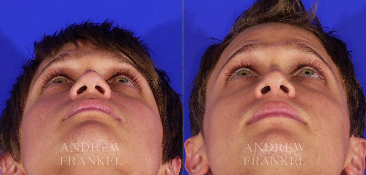Rhinoplasty before and after photos in Beverly Hills, CA, Patient 13433