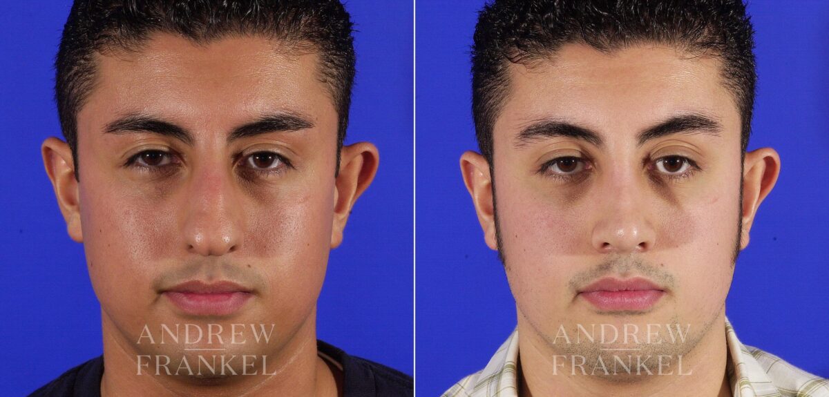 Rhinoplasty before and after photos in Beverly Hills, CA, Patient 13462