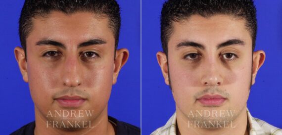 Rhinoplasty before and after photos in Beverly Hills, CA, Patient 13462