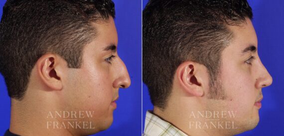 Rhinoplasty before and after photos in Beverly Hills, CA, Patient 13462