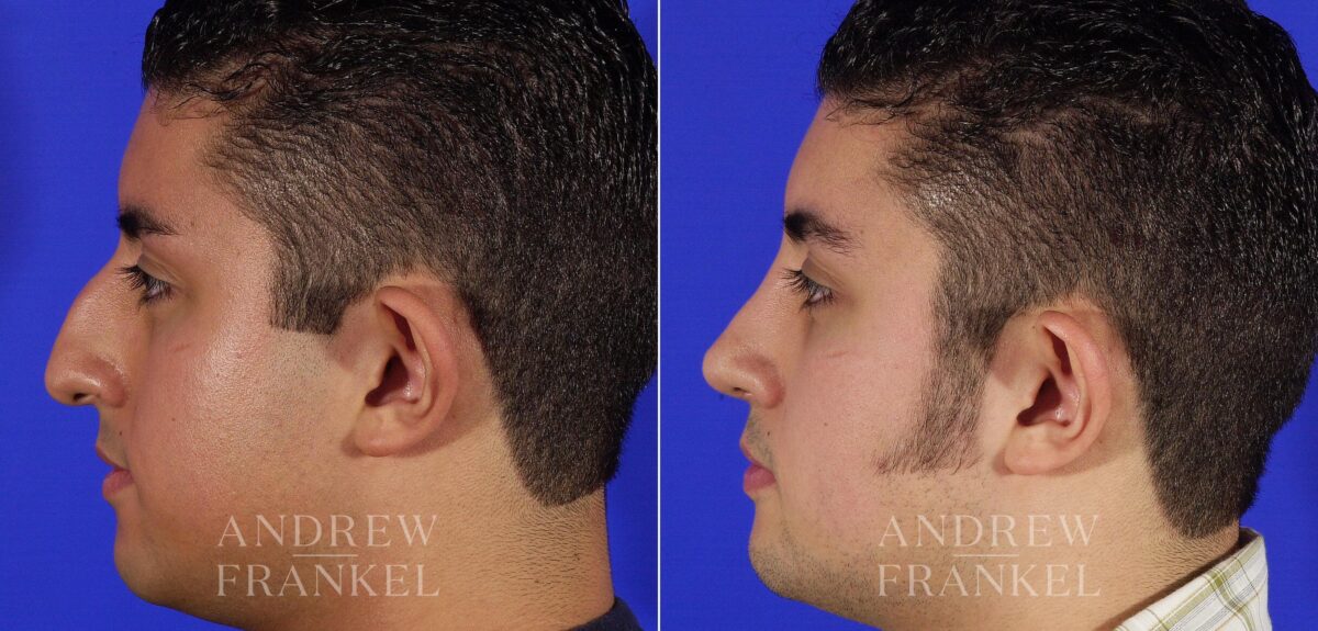 Rhinoplasty before and after photos in Beverly Hills, CA, Patient 13462