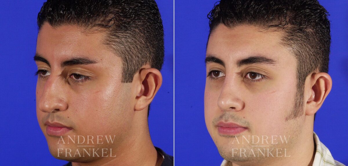 Rhinoplasty before and after photos in Beverly Hills, CA, Patient 13462