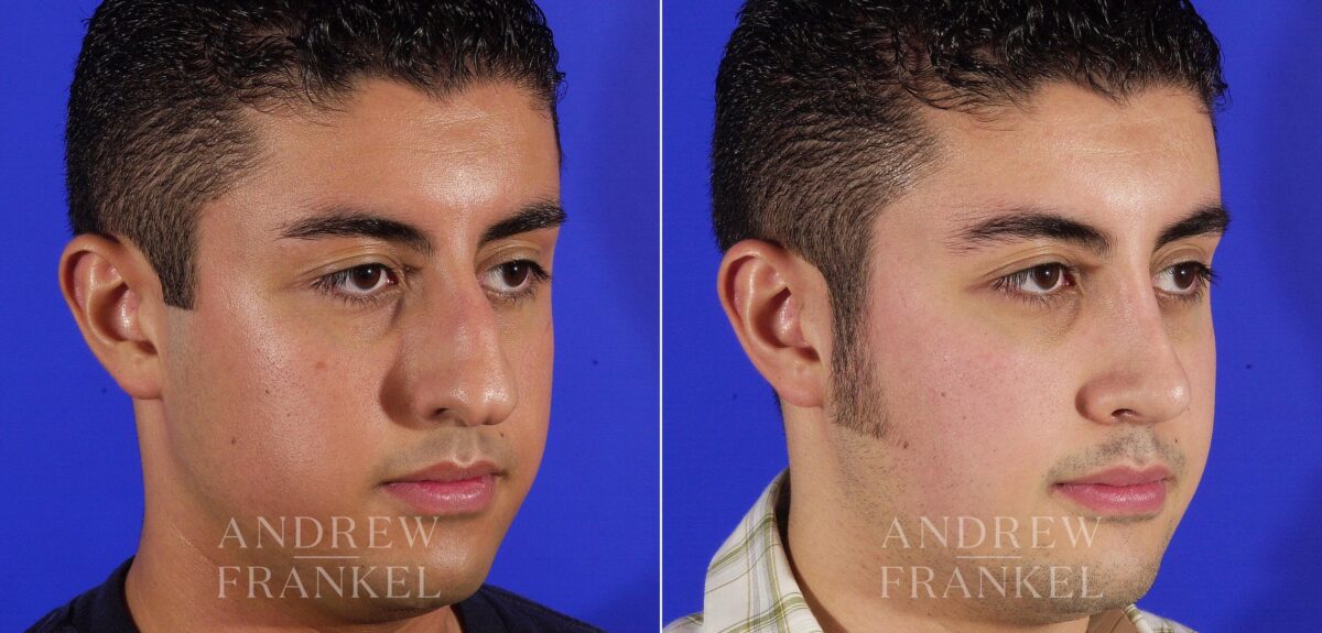 Rhinoplasty before and after photos in Beverly Hills, CA, Patient 13462