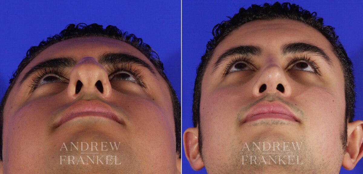 Rhinoplasty before and after photos in Beverly Hills, CA, Patient 13462