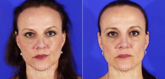 Rhinoplasty before and after photos in Beverly Hills, CA, Patient 13153