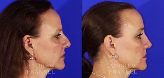 Rhinoplasty before and after photos in Beverly Hills, CA, Patient 13153