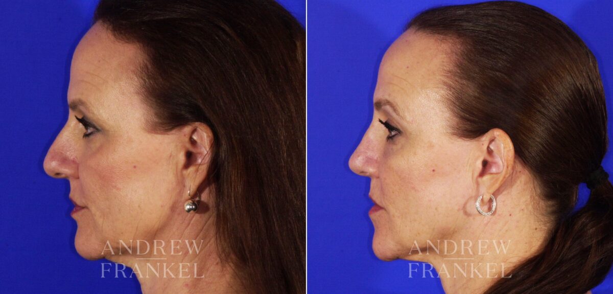 Rhinoplasty before and after photos in Beverly Hills, CA, Patient 13153