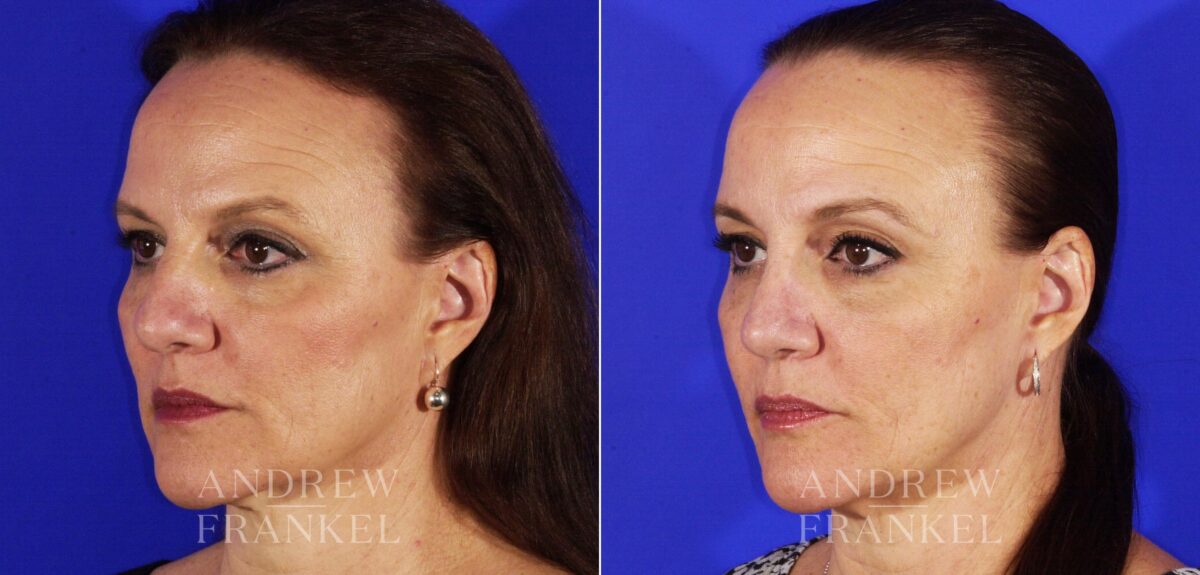 Rhinoplasty before and after photos in Beverly Hills, CA, Patient 13153