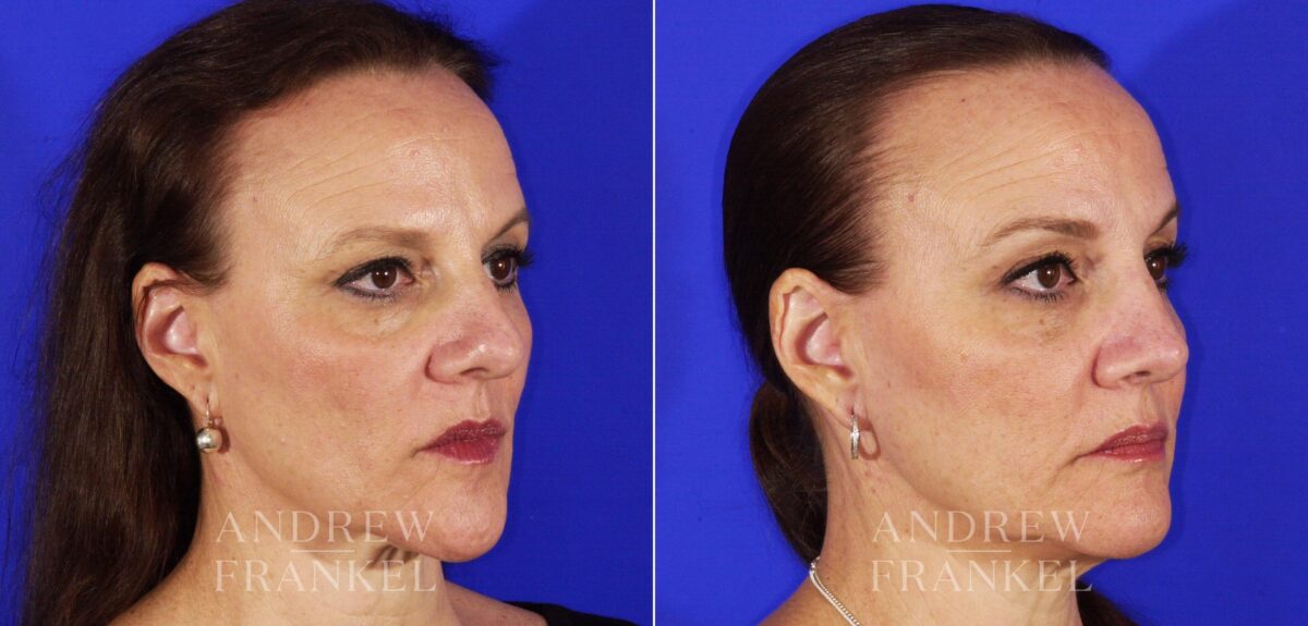 Rhinoplasty before and after photos in Beverly Hills, CA, Patient 13153