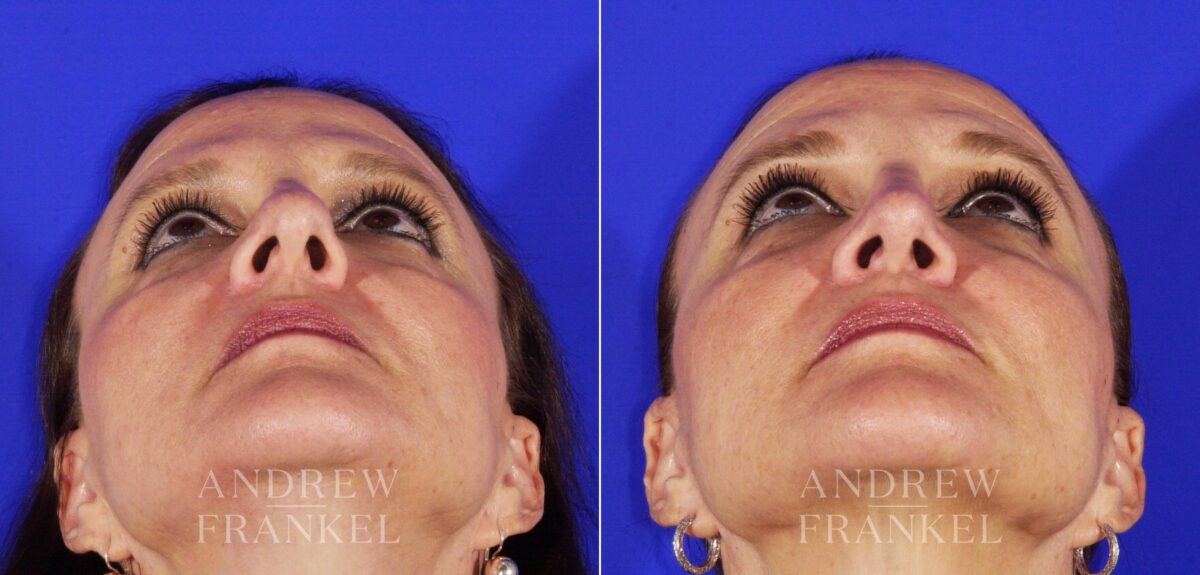 Rhinoplasty before and after photos in Beverly Hills, CA, Patient 13153