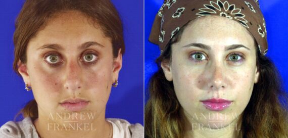 Rhinoplasty before and after photos in Beverly Hills, CA, Patient 13175