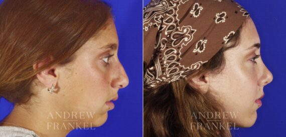 Rhinoplasty before and after photos in Beverly Hills, CA, Patient 13175