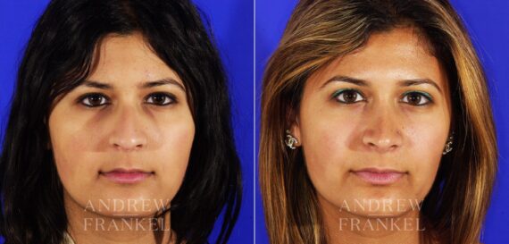 Rhinoplasty before and after photos in Beverly Hills, CA, Patient 13193