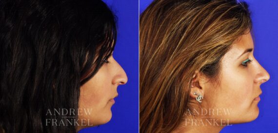 Rhinoplasty before and after photos in Beverly Hills, CA, Patient 13193