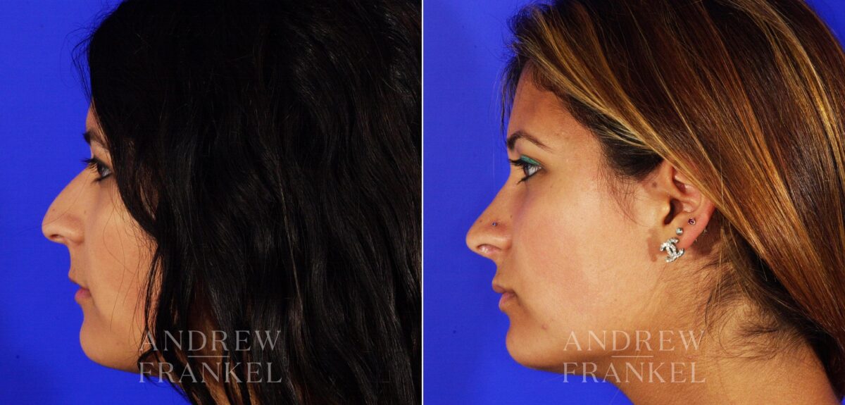Rhinoplasty before and after photos in Beverly Hills, CA, Patient 13193