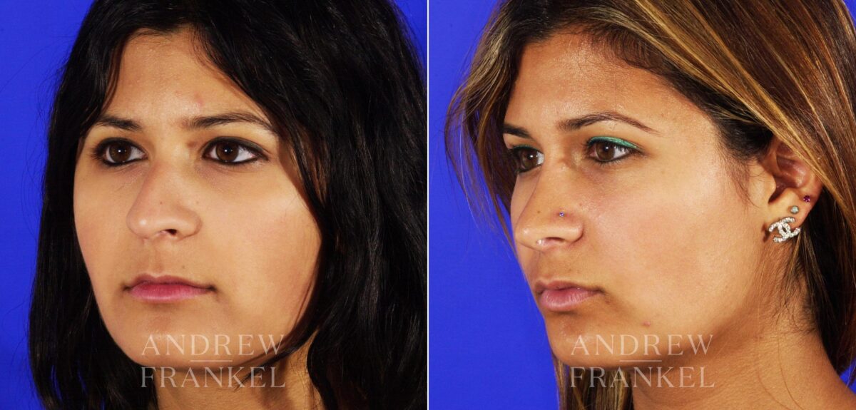 Rhinoplasty before and after photos in Beverly Hills, CA, Patient 13193