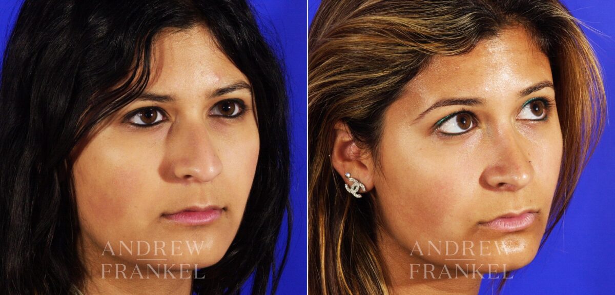 Rhinoplasty before and after photos in Beverly Hills, CA, Patient 13193
