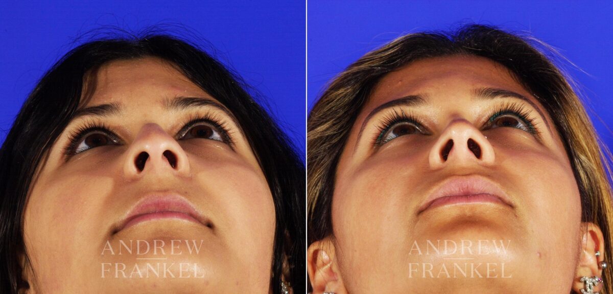 Rhinoplasty before and after photos in Beverly Hills, CA, Patient 13193