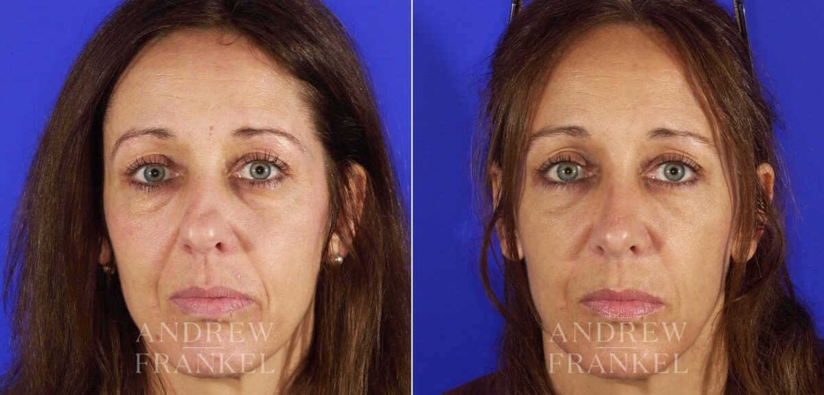 Rhinoplasty before and after photos in Beverly Hills, CA, Patient 13230