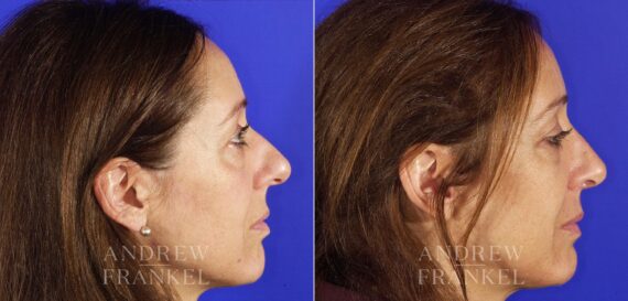 Rhinoplasty before and after photos in Beverly Hills, CA, Patient 13230