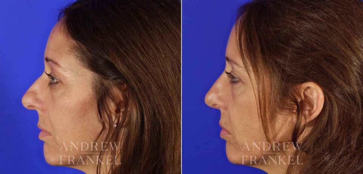 Rhinoplasty before and after photos in Beverly Hills, CA, Patient 13230
