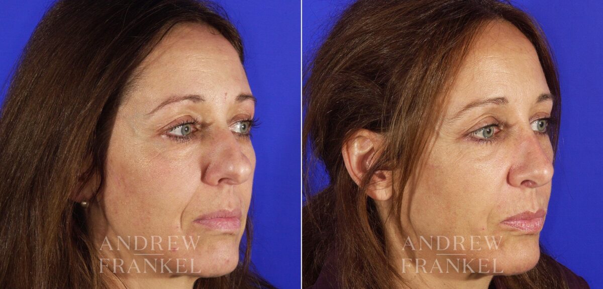 Rhinoplasty before and after photos in Beverly Hills, CA, Patient 13230