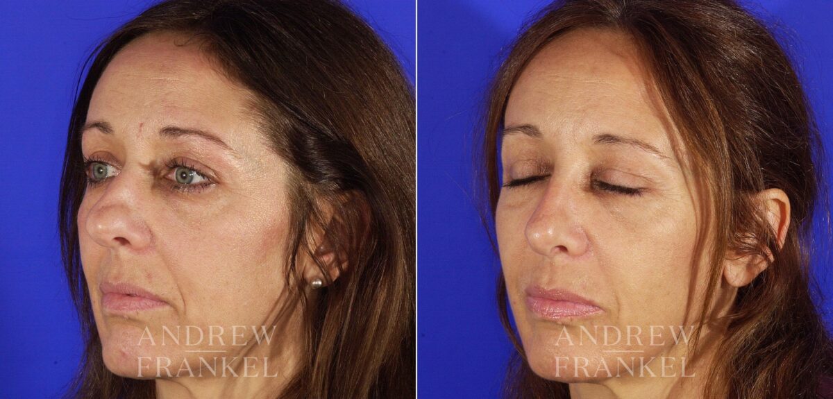 Rhinoplasty before and after photos in Beverly Hills, CA, Patient 13230