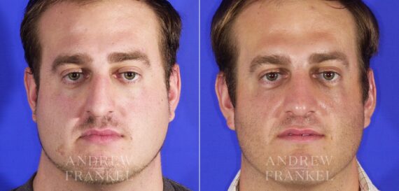 Rhinoplasty before and after photos in Beverly Hills, CA, Patient 13248