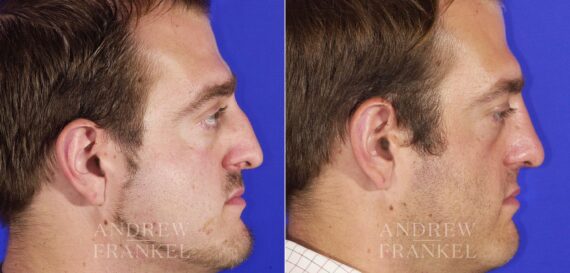 Rhinoplasty before and after photos in Beverly Hills, CA, Patient 13248