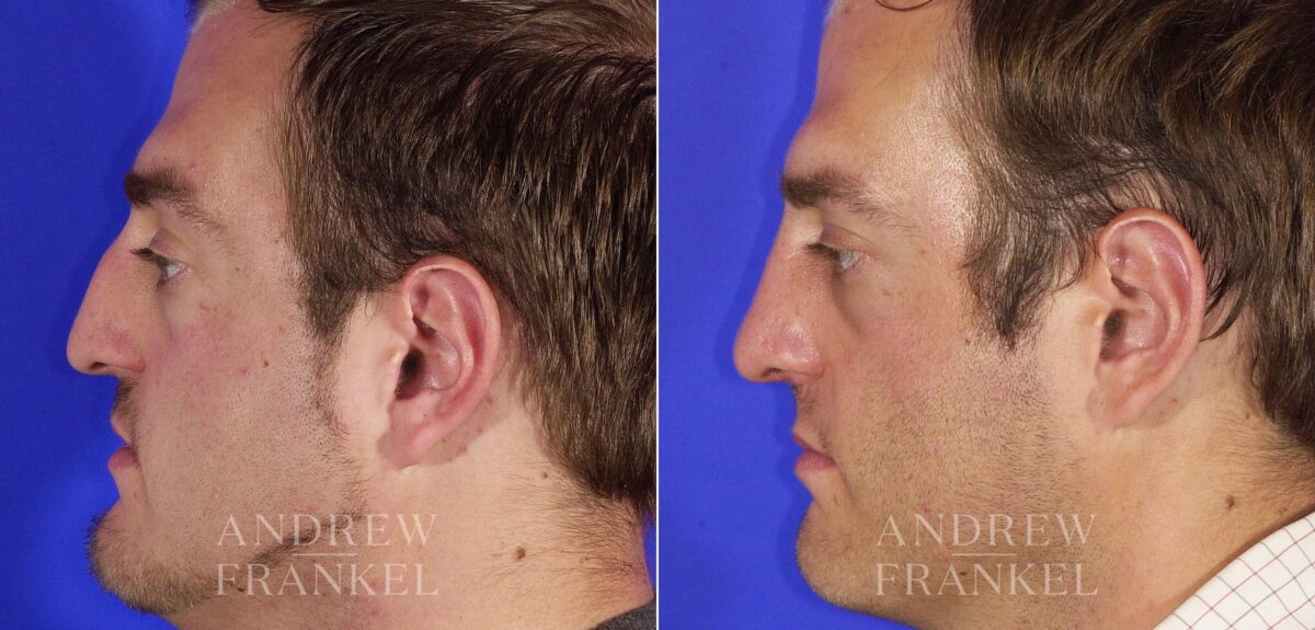 Rhinoplasty before and after photos in Beverly Hills, CA, Patient 13248