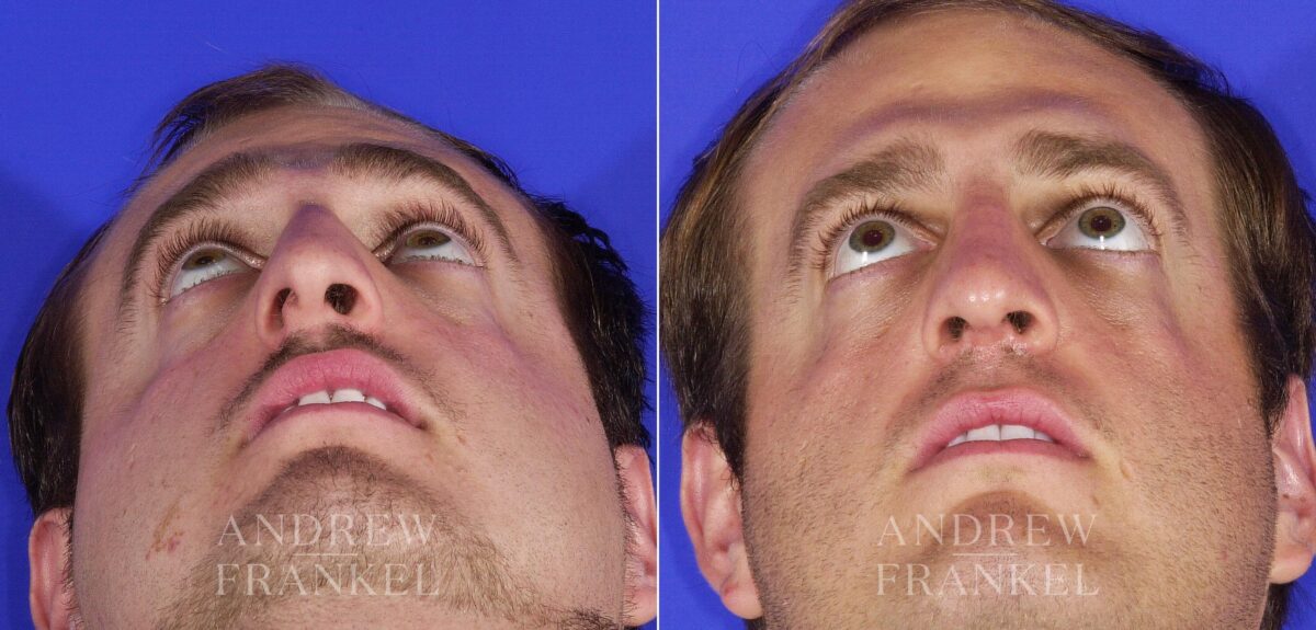 Rhinoplasty before and after photos in Beverly Hills, CA, Patient 13248