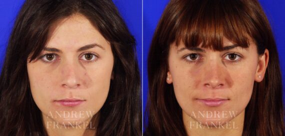 Rhinoplasty before and after photos in Beverly Hills, CA, Patient 13334