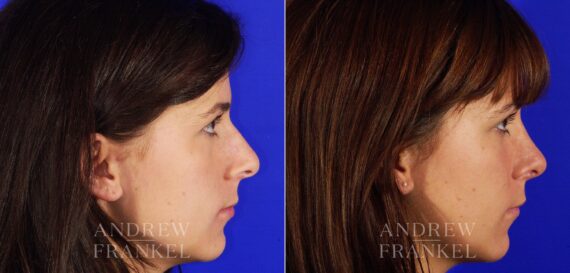 Rhinoplasty before and after photos in Beverly Hills, CA, Patient 13334