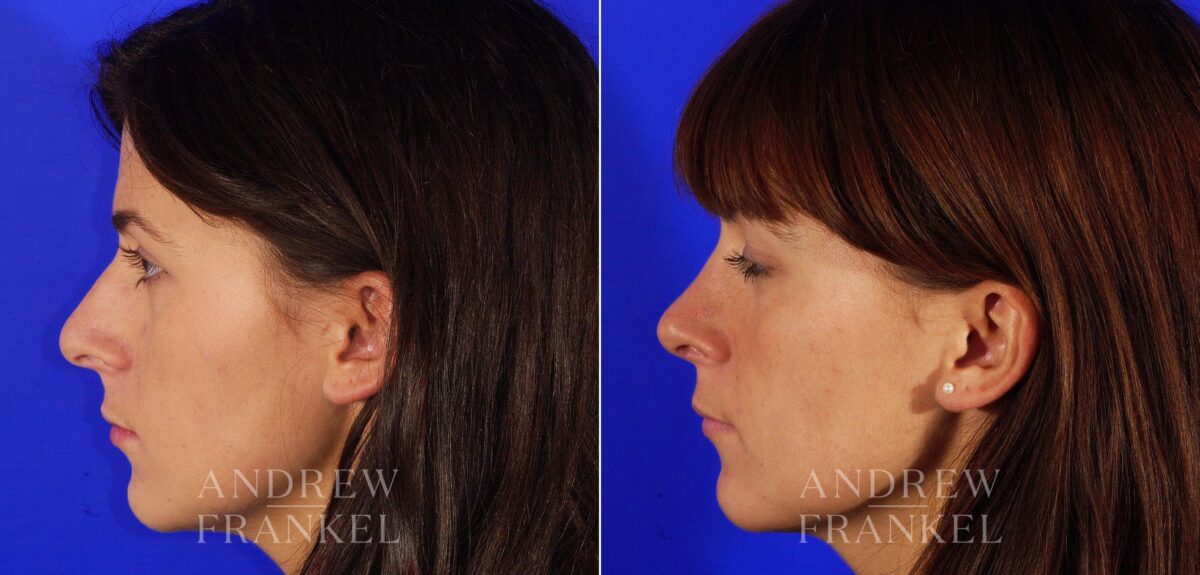 Rhinoplasty before and after photos in Beverly Hills, CA, Patient 13334