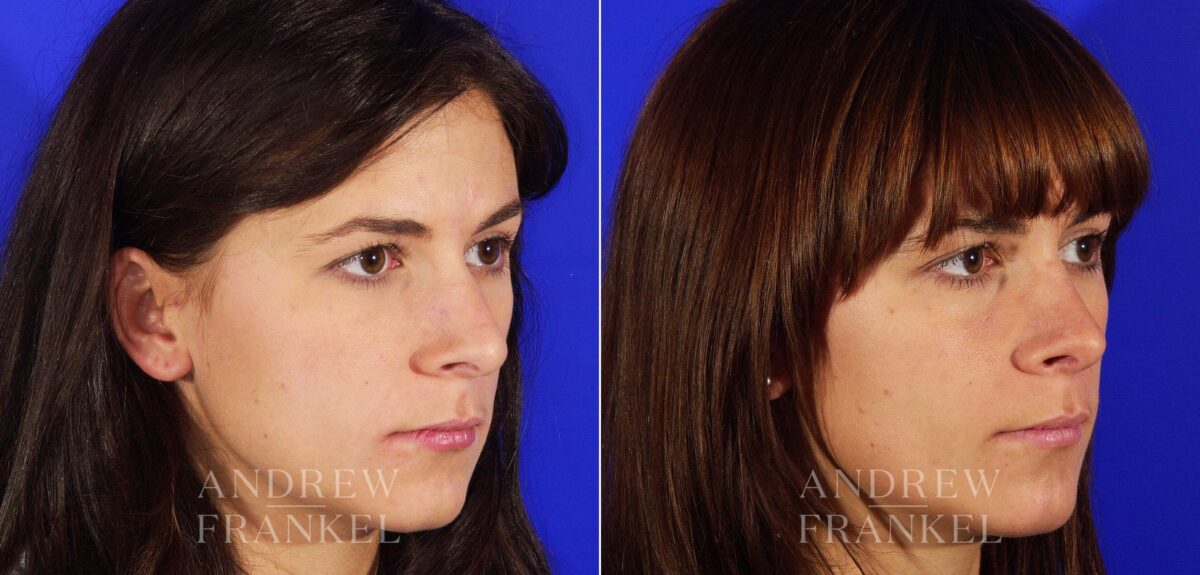 Rhinoplasty before and after photos in Beverly Hills, CA, Patient 13334