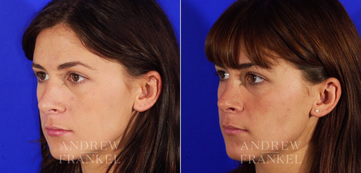 Rhinoplasty before and after photos in Beverly Hills, CA, Patient 13334