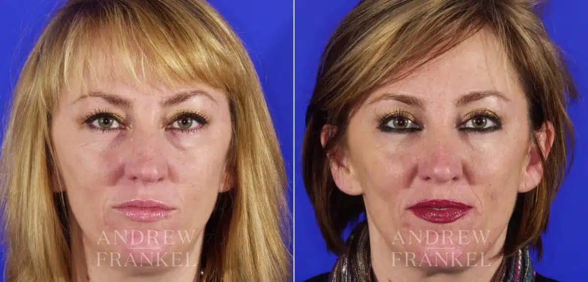 Rhinoplasty before and after photos in Beverly Hills, CA, Patient 13408