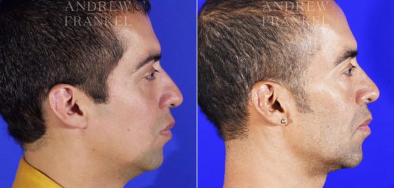 Jawline Contouring before and after photos in Beverly Hills, CA, Patient 14529