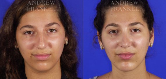 Jawline Contouring before and after photos in Beverly Hills, CA, Patient 14563