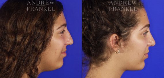 Jawline Contouring before and after photos in Beverly Hills, CA, Patient 14563